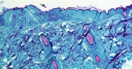 Dubai authority's advisory lists for Monkeypox