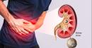 Kidney Stones: Symptoms, Treatment and Prevention